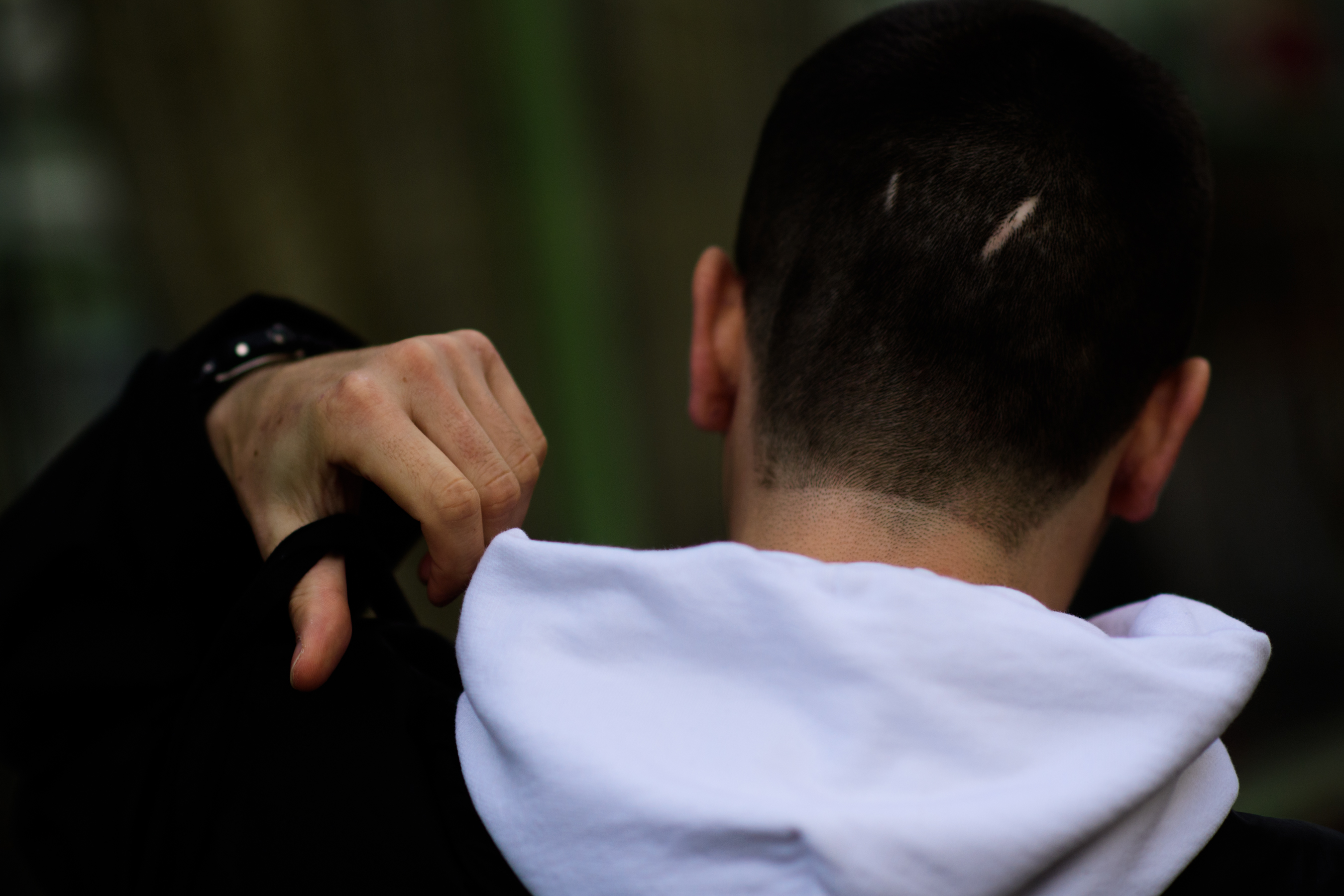 Russian man with scars on his head