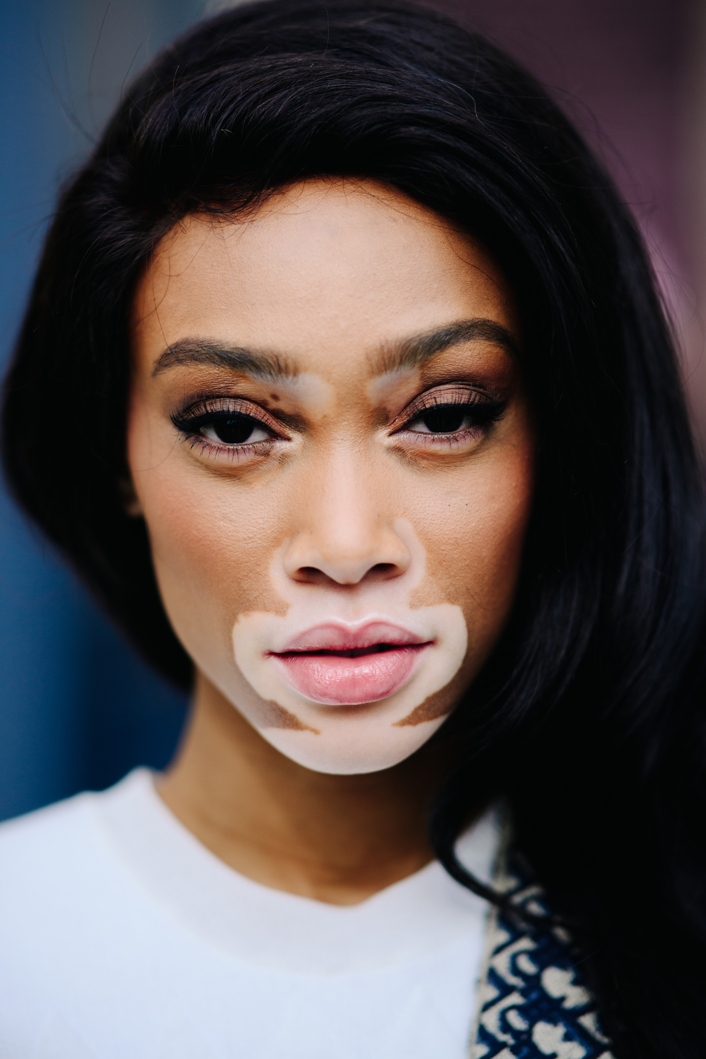 Portrait of a Canadian model with vitiligo