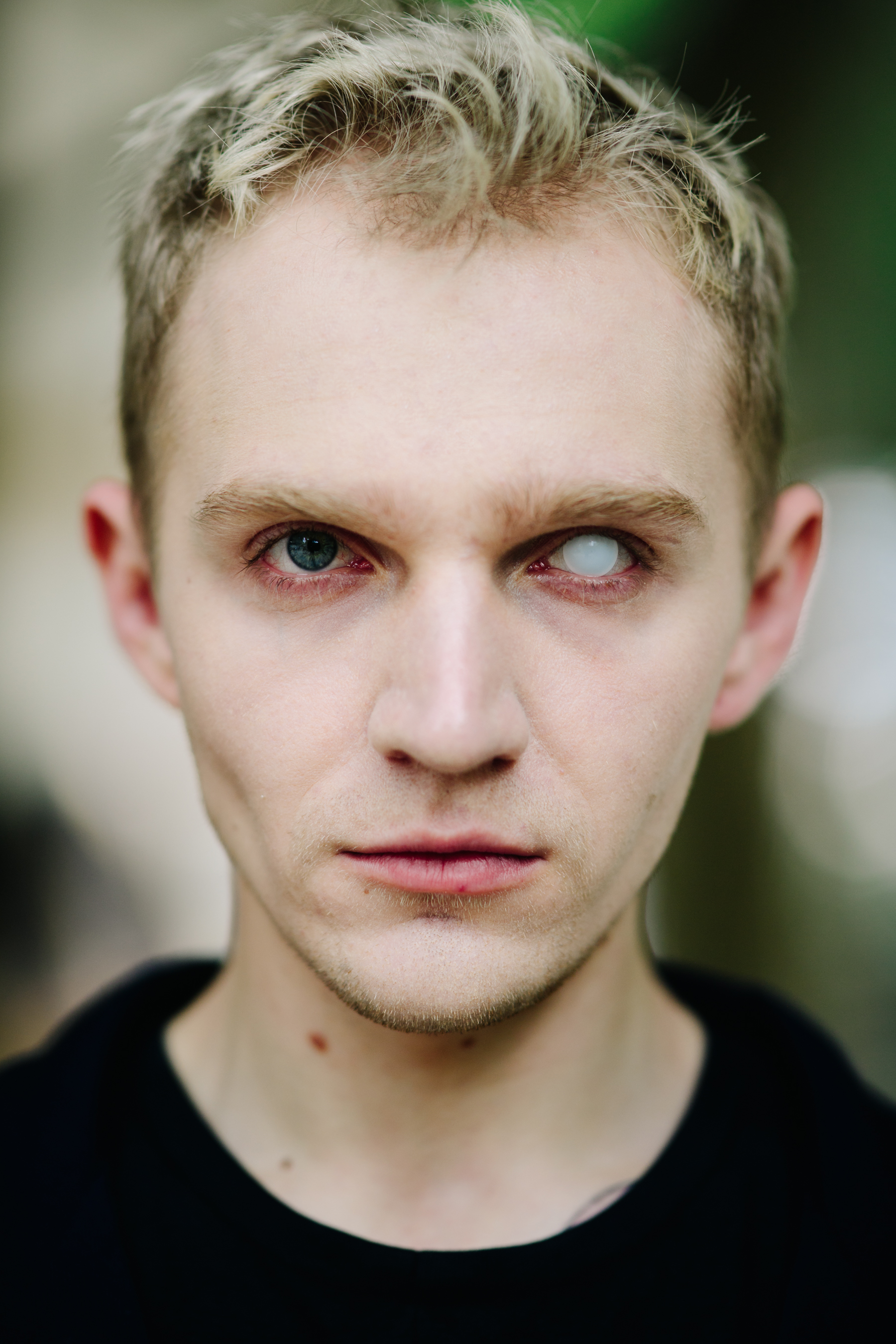 Boy wearing a white eye lense